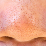 Komedo Hitam Dan Komedo Putih Kini Kerap Menjadi Perhatian