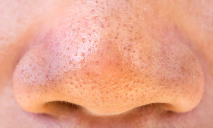 Komedo Hitam Dan Komedo Putih Kini Kerap Menjadi Perhatian