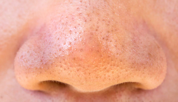 Komedo Hitam Dan Komedo Putih Kini Kerap Menjadi Perhatian