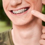 Cara Perawatan Gigi Memakai Berbehel Yang Harus Di Perhatikan