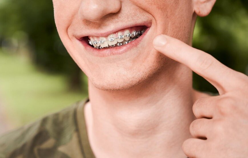 Cara Perawatan Gigi Memakai Berbehel Yang Harus Di Perhatikan