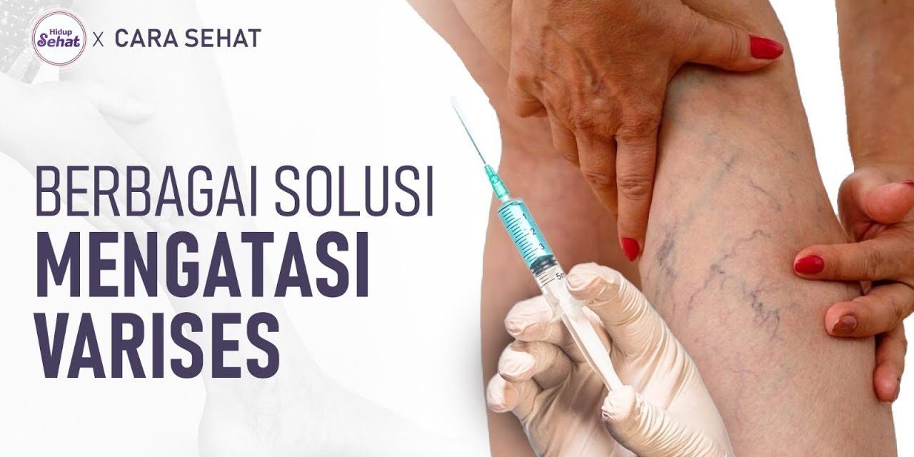 Tindakan Skleroterapi Prosedur Medis Untuk Mengatasi Varises