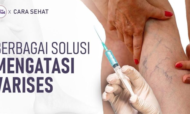 Tindakan Skleroterapi Prosedur Medis Untuk Mengatasi Varises