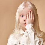 Kondisi Kulit Albino, Benarkah Penyakit Ini Bisa Menular?