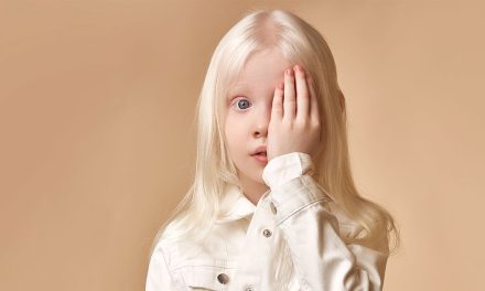 Kondisi Kulit Albino, Benarkah Penyakit Ini Bisa Menular?