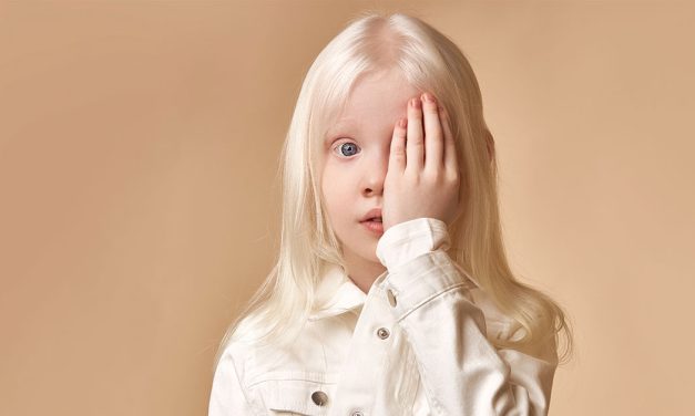 Kondisi Kulit Albino, Benarkah Penyakit Ini Bisa Menular?