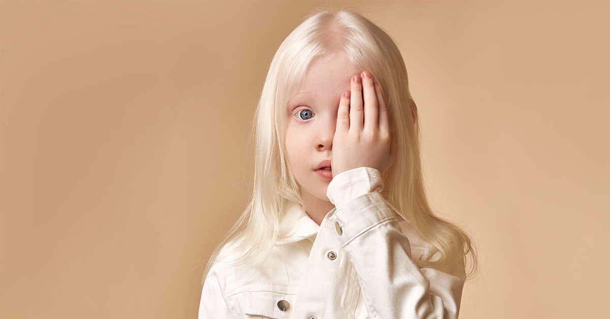Kondisi Kulit Albino, Benarkah Penyakit Ini Bisa Menular?